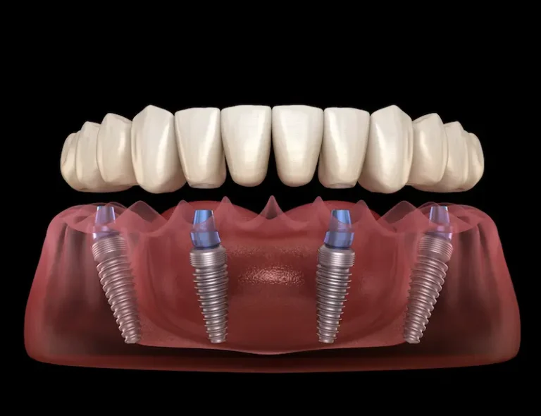 An illustrated, transparent gum line shows All-on-4 implants anchored.