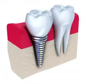 Parts of a dental implant