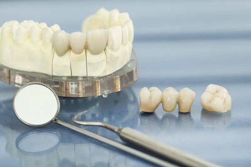 Full mouth restoration is represented by a dental implant bridge, dentist tools, and a model jawbone with teeth.