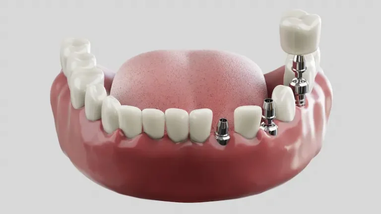 An illustrated design of dental implants for multiple tooth loss.