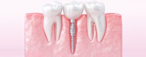 Consider Dental Implants
