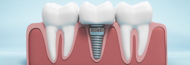 Dental Convention Dental Implants