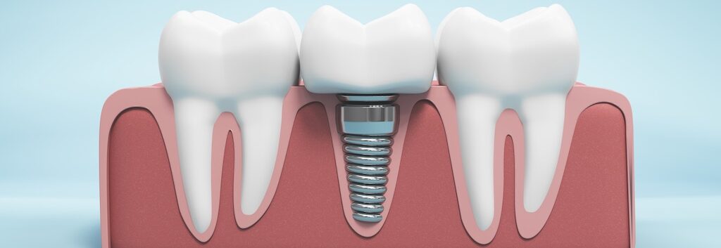 Dental Convention Dental Implants