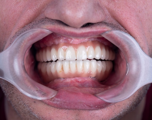 Full Mouth Dental Implants