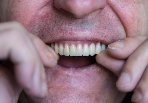 Man Putting In Dentures - Overdentures vs Fixed Implant Bridges