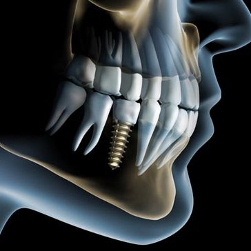 Dental implant rendering